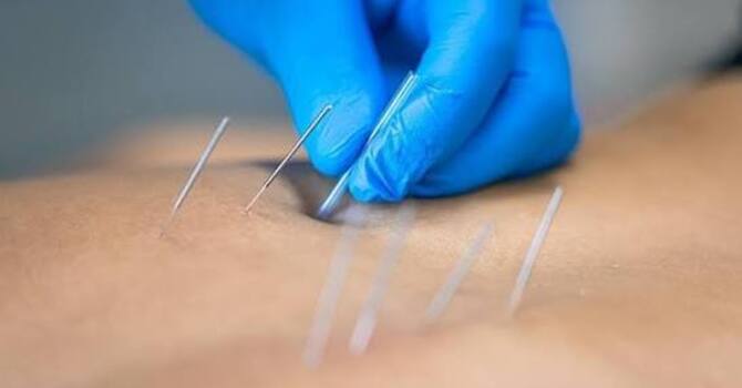 Dry Needling