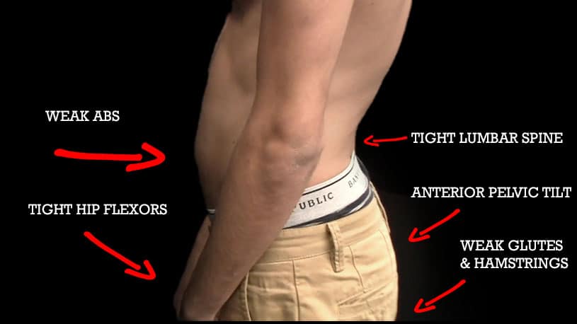Anterior Pelvic Tilt.. What is it? What can I do about it?
