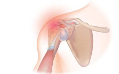 I have a tear in my rotator cuff – What does that mean?